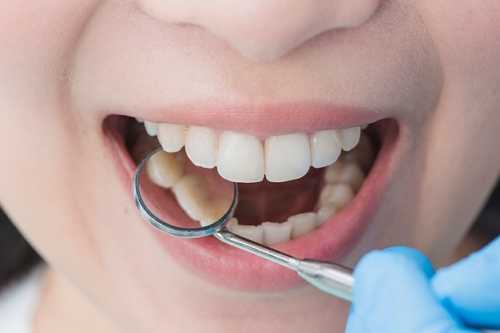 牙齒內部爲什麽會長髓石？