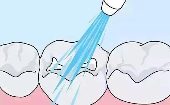 根管治療後點解仲會有冷熱刺激痛呀？