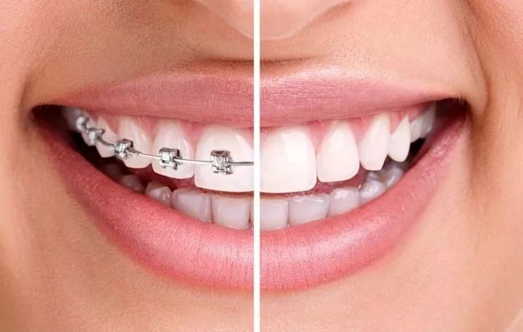 牙齒矯正係唔係越早越好，黃金年齡係咩時候？