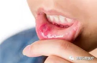 口腔癌嘅臨牀表現有哪些？