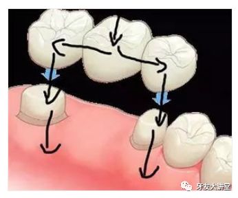 牙科醫生說說 “殺神經”同埋“根管治療”