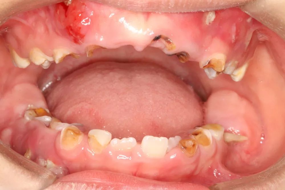 乳牙壞左唔用管？未及時治療，4歲男童一口牙幾乎爛光