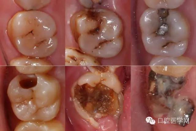 小牙洞，大問題！