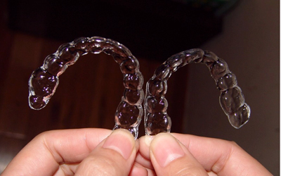 矯正牙齒，注意這四點，讓你避開陷阱