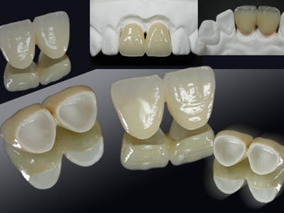 鑲牙烤瓷牙跟種植牙的利與弊有哪些？