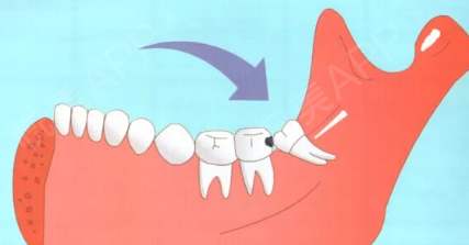 智齒到底該不該拔？