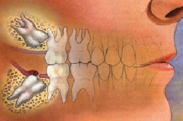 智齒長歪了一定要拔掉嗎？