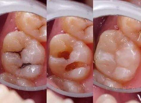 塗氟還是窩溝封閉？預防孩子乳牙齲壞