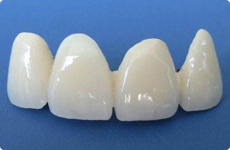 為什麼看牙醫套個烤瓷牙要那麼貴？