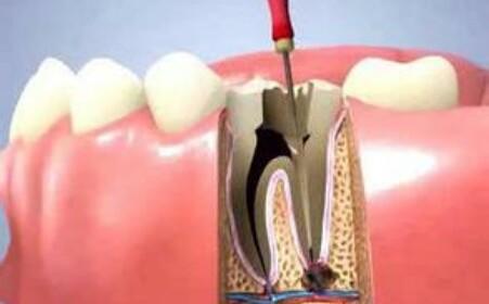 小孩牙齦上長了個包，裏面好像有膿怎麼辦？