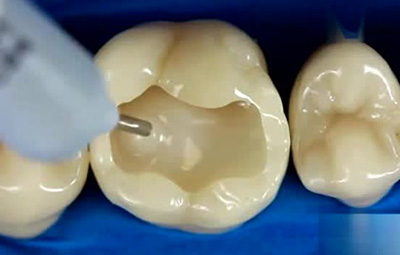 關於補牙的七個困惑，專家為您解答