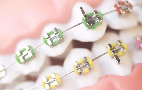 牙齒矯正的最佳年齡，真相不是你想象的那樣