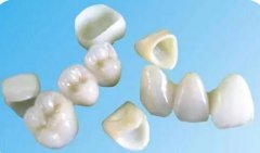 一起睇睇全瓷牙優勢有邊D呢？