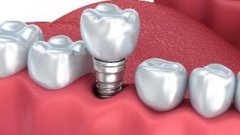 種牙後飲食上要註意邊d問題？