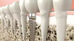 種完牙後能食煙飲酒嗎？