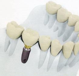 種牙手術後可以吃流食嗎