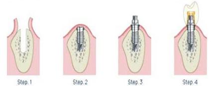 種牙流程