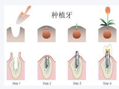 種牙該如何保養