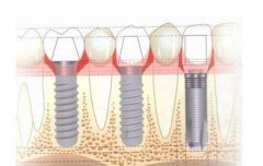 多顆種牙後點樣護理?