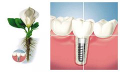種牙點解要精心護理？