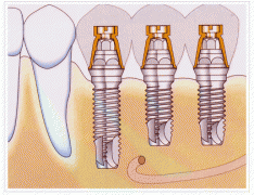 種牙前後嘅注意事項系點樣呢？