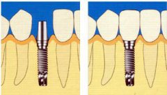 如何正確保養種牙？