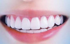 如何預防種植體牙周炎？