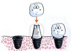 多顆種牙後需要點護理