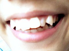 虎牙會產生哪些危害？