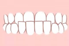 兒童牙齒地包天如何矯正