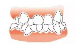 牙列擁擠矯正有幾種方法？