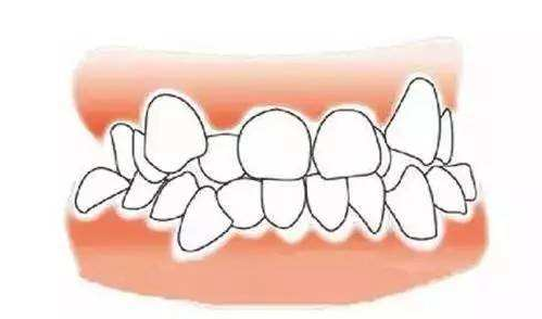 牙列擁擠矯正