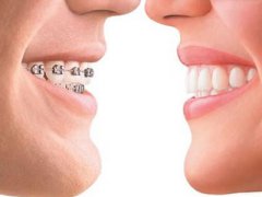 虎牙矯正最佳方法是什麼？