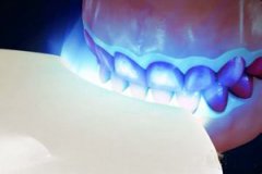 冷光美白牙齒術後效果明顯嗎