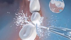 維港口腔科普:關於洗牙嘅誤區