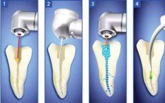 牙髓炎可以杜牙根嗎？