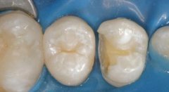 三種情況下需要做杜牙根