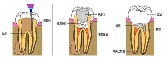 兒童乳牙杜牙根嘅注意事項