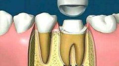 杜牙根後唔做牙套可以嗎？