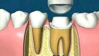杜牙根後唔做牙冠可以嗎