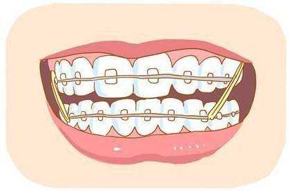 箍牙過程時長