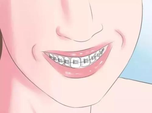 箍牙導致牙齒松動