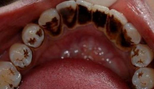 牙齒變黑原因