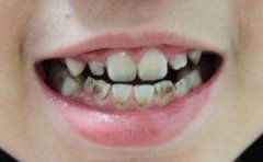 黑牙嘅危害具體有哪些？