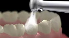 什麼是洗牙？洗牙原理系咩？