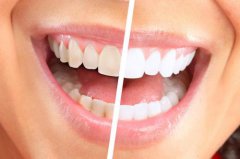 黃牙預防有咩方法？