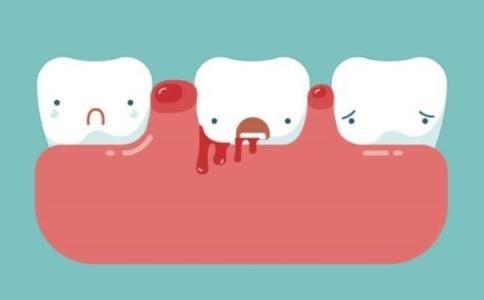 牙齦出血嘅預防