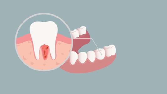 牙周炎治療方案