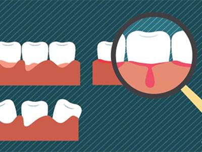 牙齦出血常見原因
