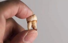 原嚟牙齦發炎都有好多唔同類型？